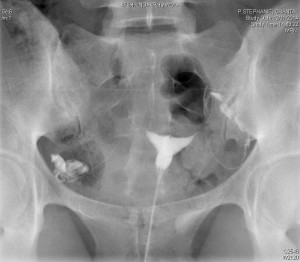 Observation d'un implant vaginal par radiographie. - Crédits : CPMA